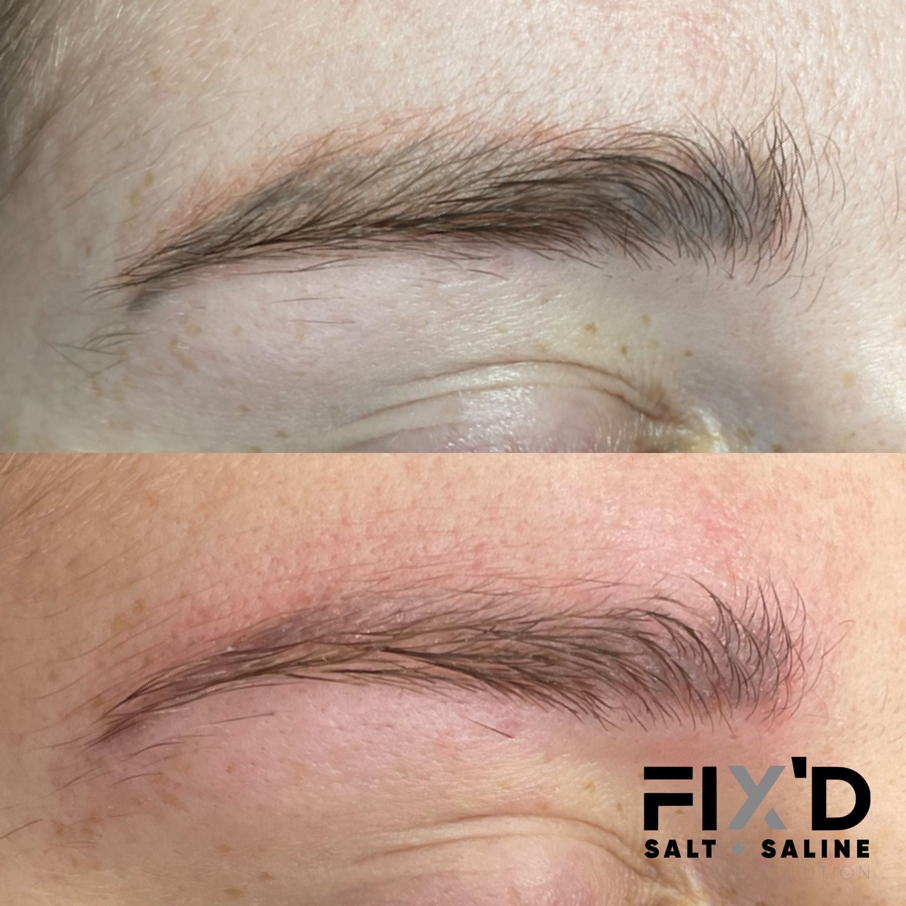 What is salt and saline tattoo removal